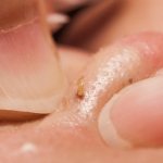 11 ways to cleanse your skin of sebaceous plugs and get rid of acne