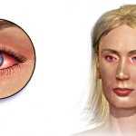 Аллергия на глазах - причины и симптомы