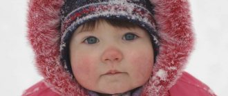 Allergy to cold in children