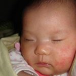 Allergy on the cheeks of a child - photo