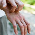 Vitamin deficiency on the hands: causes, treatment, prevention