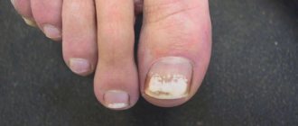 white toenails