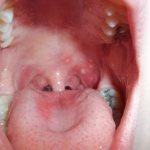 White pimples in throat