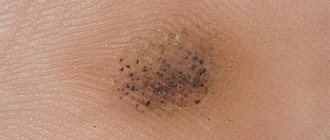 wart with black spots