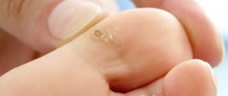 Warts that occur on the toes do not always need to be removed