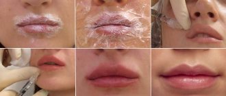 How to smear lips after lip augmentation with hyaluronic acid?