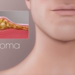 What is a lipoma and why does it appear?