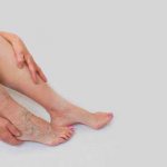 What are internal varicose veins