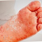 What causes a rash on a child&#39;s feet?