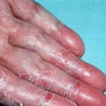 Dermatitis on hands