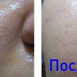 before and after removal of blackheads on face