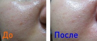 до и после удаления черных точек на лице