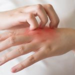 Effective treatment for eczema on fingers