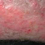 Eczema in the groin in most cases is fraught with many complications