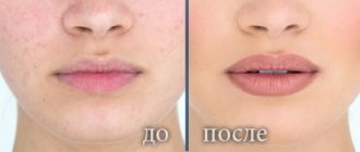 Гранулы Фордайса и перманентный макияж губ. Фото до и после, отзывы