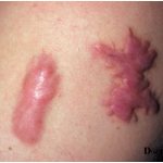 Surgical scars (traumatic scars) - keloid scars