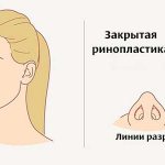Хирургический доступ при пластике седловидного носа