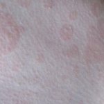 Из-за каких заболеваний появляются на поверхности кожи пятна розового цвета