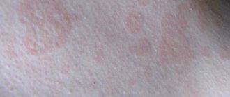 What diseases cause pink spots to appear on the surface of the skin?