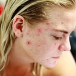 You can get rid of acne by cleansing your body, photo