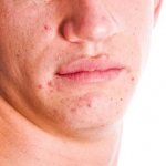 Why do you dream about acne on your face?