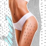 how to get rid of stretch marks without harm
