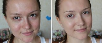 how to even out skin tone after acne