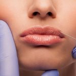 How to remove hyaluronic acid from lips