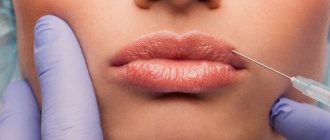 Как вывести гиалуроновую кислоту из губ