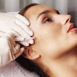 What treatments will help with acne?