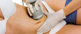 kavitatsiya otzyivyi do i posle foto - Ultrasonic cavitation