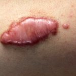Keloid scar: photo of symptoms