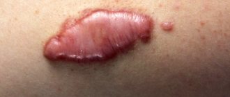 Keloid scar: photo of symptoms