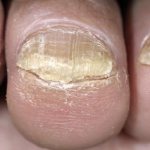кератоз при грибке ногтя