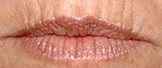 Purse-string wrinkles above the upper lip