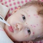 When can you wash yourself if you have chickenpox?