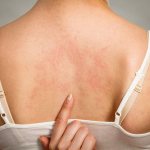 Urticaria in an adult photo
