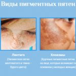 Achromin cream for age spots. Reviews from doctors, instructions for use, indications and contraindications, before and after photos 