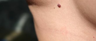 Laser hair removal should be done with caution if you have moles