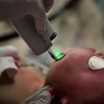 Laser therapy for capillary malformation