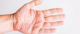 Treatment of weeping eczema