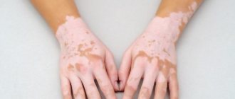 Treatment of vitiligo in children
