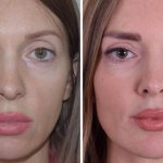 Липофилинг лица фото до и после