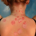 Ringworm and Fungus: signs of the disease and methods of treatment