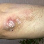 Elbow psoriasis