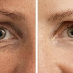 Mesotherapy for the skin around the eyes