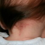 A red spot appears on the back of the newborn&#39;s head