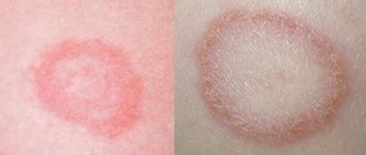 What disease is indicated by a spot on the skin with a red rim?