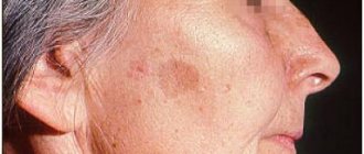 A lesion of solar lentigo on a woman&#39;s cheek
