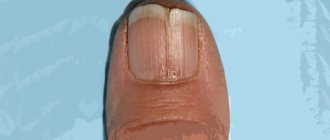 Онихорексис или трещина вдоль ногтя